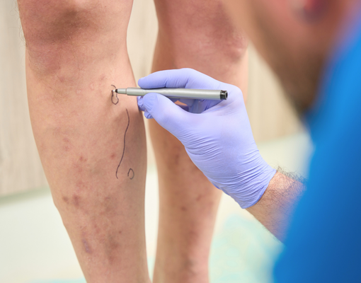 Varicose Veins Treatment